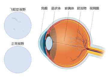 专家科普|我的眼前怎么有“蚊子”在飞？患者|飞蚊症|蚊子