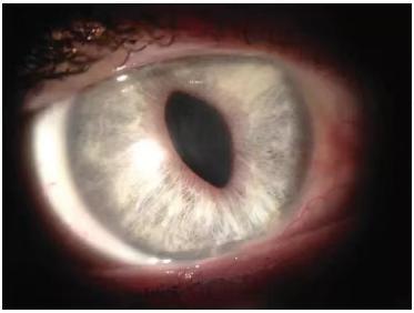 Is it the sequela of COVID-19? The truth is... the pupils suddenly turn into triangular pupils | eyes | sequelae