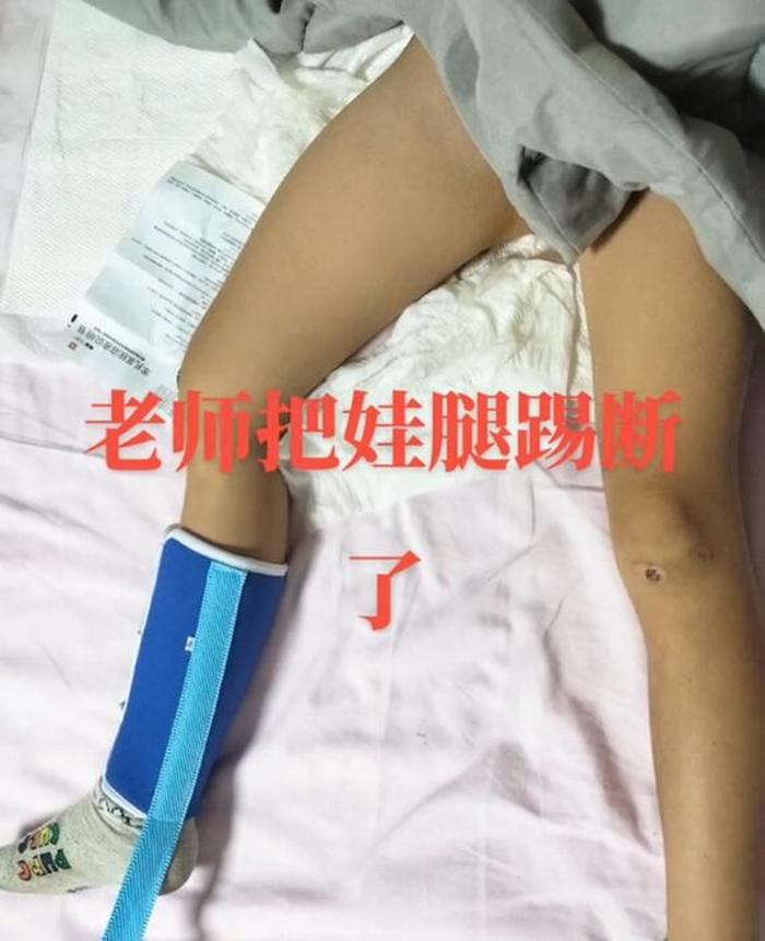 陕西周至一学生被老师踢断腿骨？教科局：正跟进处理