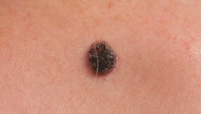 Expert Science Popularization | Can moles on the body become melanoma? More than 80% of patients miss the opportunity for treatment. Melanocytes | Black line | Treatment