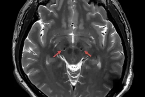 Can NMR still be done? The Renji team implanted the latest domestically produced brain pacemaker into a patient, who suffered from Parkinson's disease at the age of 40