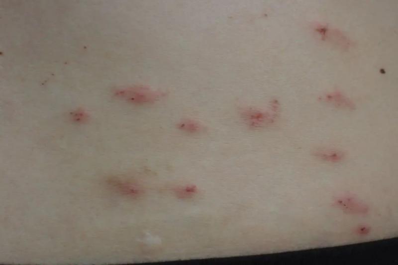 A couple in Hangzhou are covered in red rashes all over their bodies! There have been many people who have been recruited recently. After watching a movie, Zhong Jianbo | Chen He | Couple