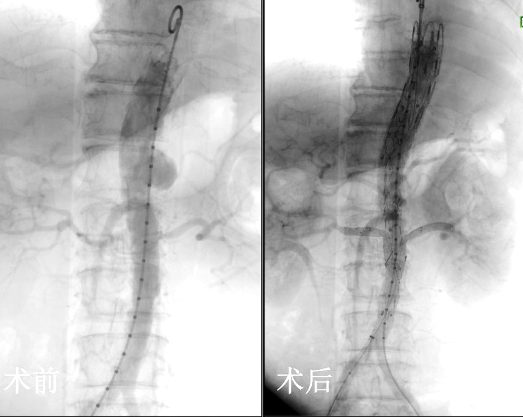 Unexpectedly Abdominal Aortic Dissection: Domestic Upgrade "Four Windows" Challenge Intraluminal Treatment Forbidden Area, Female Abdominal Pain for Two Months Xue Guanhua | Ms. | Domestic