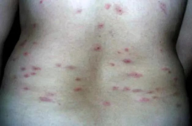 A couple in Hangzhou are covered in red rashes all over their bodies! There have been many people who have been recruited recently. After watching a movie, Zhong Jianbo | Chen He | Couple