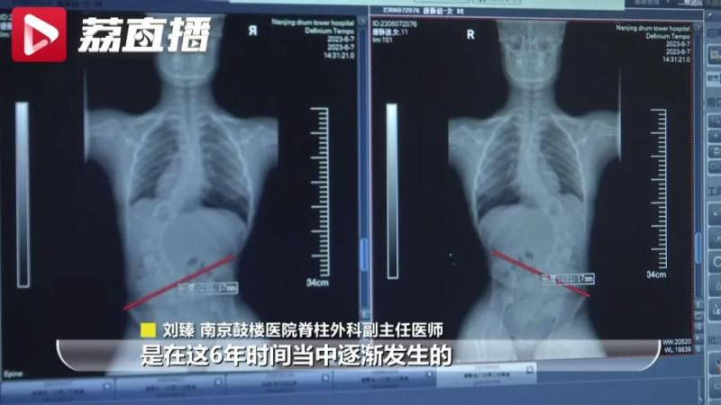 The Ministry of Education and the China Consumers Association have issued reminders!, Received 5 cases of "lower back paralysis" in 3 weeks Dance | Child | Ministry of Education