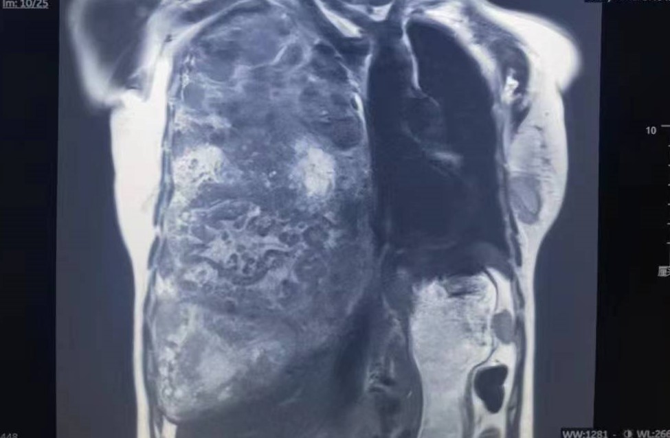 九院胸外科为患者成功保肺,37厘米巨大纤维瘤几乎占满右胸腔手术|肿瘤|胸外科
