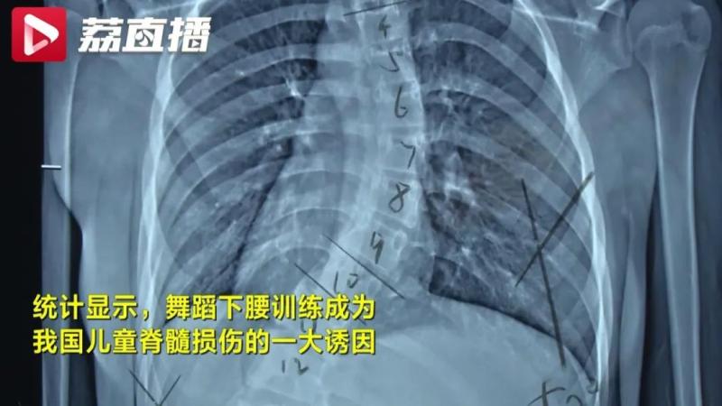 The Ministry of Education and the China Consumers Association have issued reminders!, Received 5 cases of "lower back paralysis" in 3 weeks Dance | Child | Ministry of Education