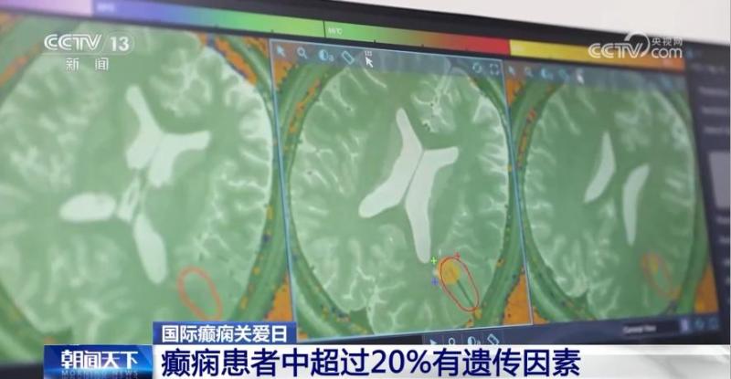 More than 20% is related to genetics! This disease adds hundreds of thousands of people every year... epilepsy | patients | related