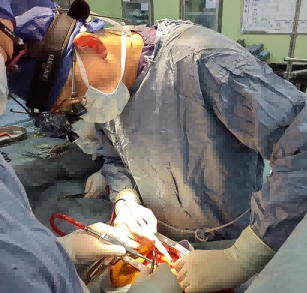 A 7-year-old boy who appears to have a "chicken chest" actually hides a huge tumor! Xinhua experts complete a 5-hour bomb disposal surgery | Tumor | Xinhua