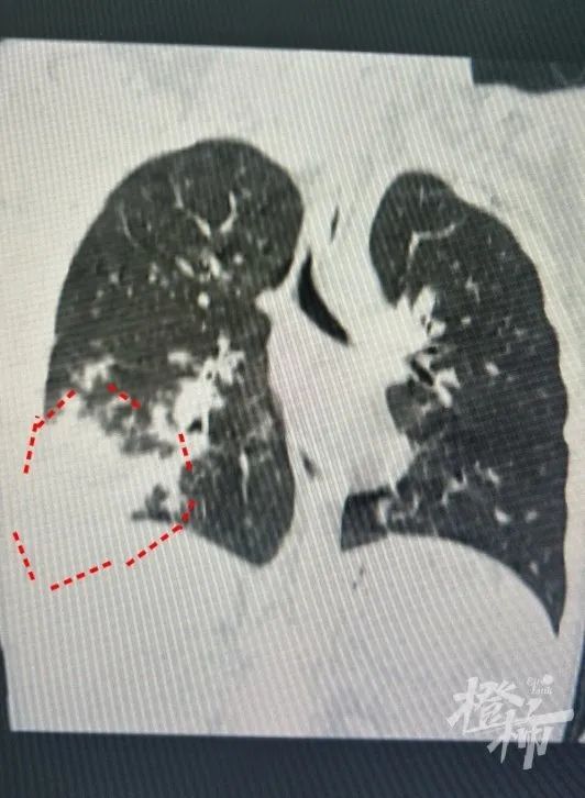 A child coughs for three weeks and their left lung turns white! Be careful of this highly disguised pneumonia recently. Seven children undergo bronchoscopy in the morning during the high incidence period | children | children